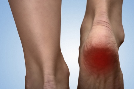 Heel Pain Help for Active Feet