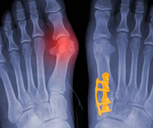 Lapiplasty 3D Bunion Correction